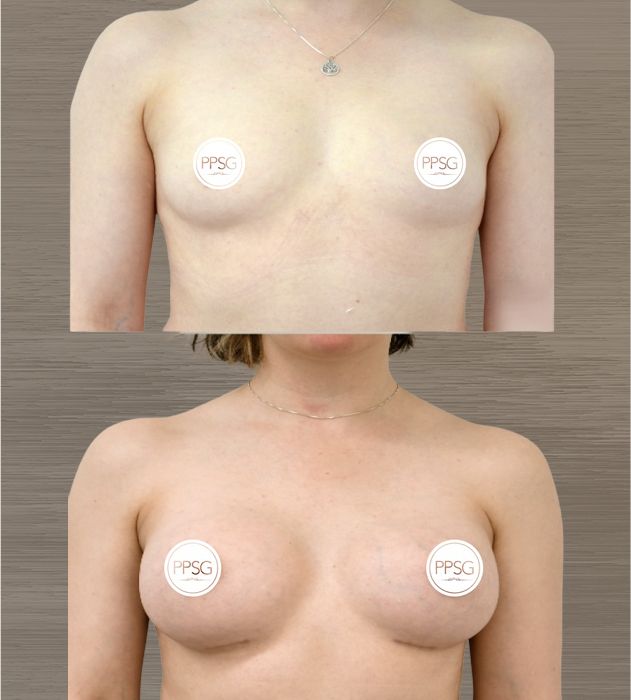 Before and after breast enhancement images.