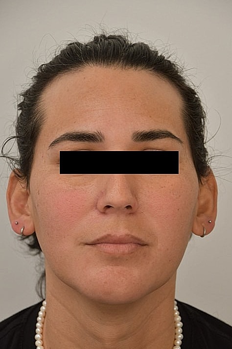 Facial Feminization Surgery Before & After