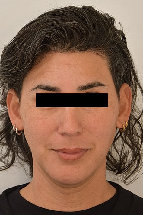 Facial Feminization Surgery Before & After