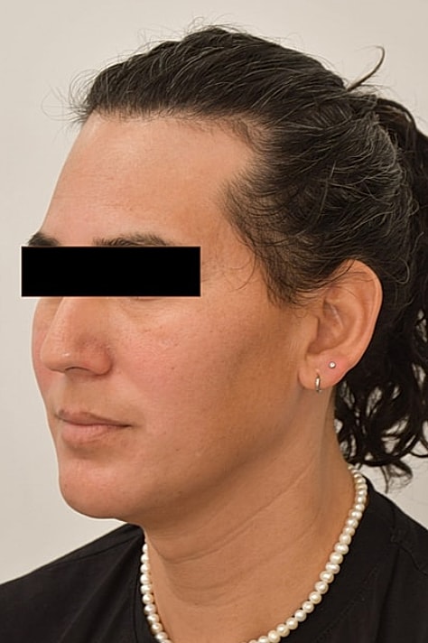 Facial Feminization Surgery Before & After