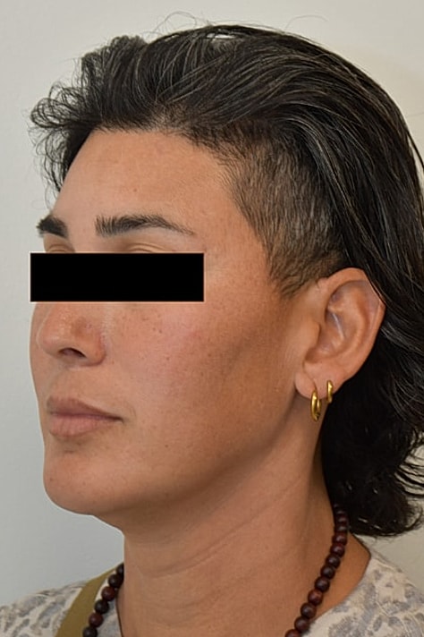 Facial Feminization Surgery Before & After