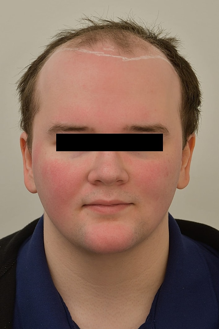 Facial Feminization Surgery Before & After