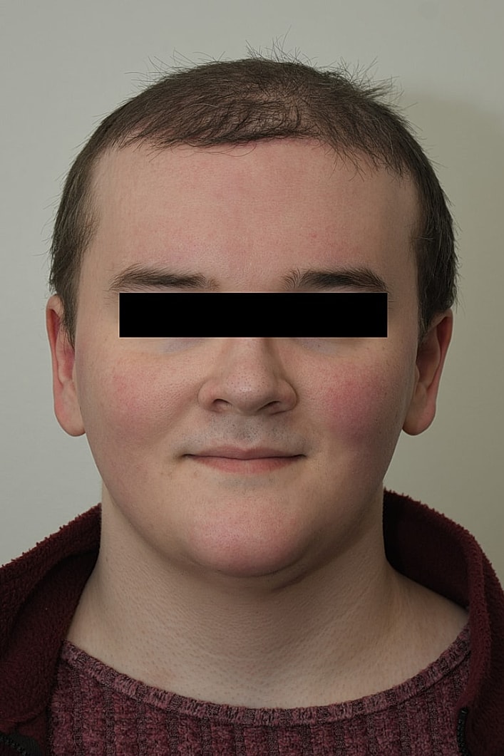 Facial Feminization Surgery Before & After