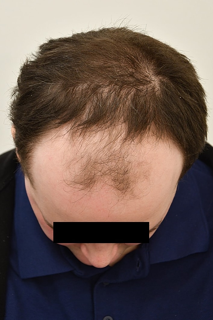 Facial Feminization Surgery Before & After