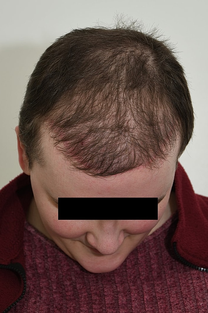 Facial Feminization Surgery Before & After