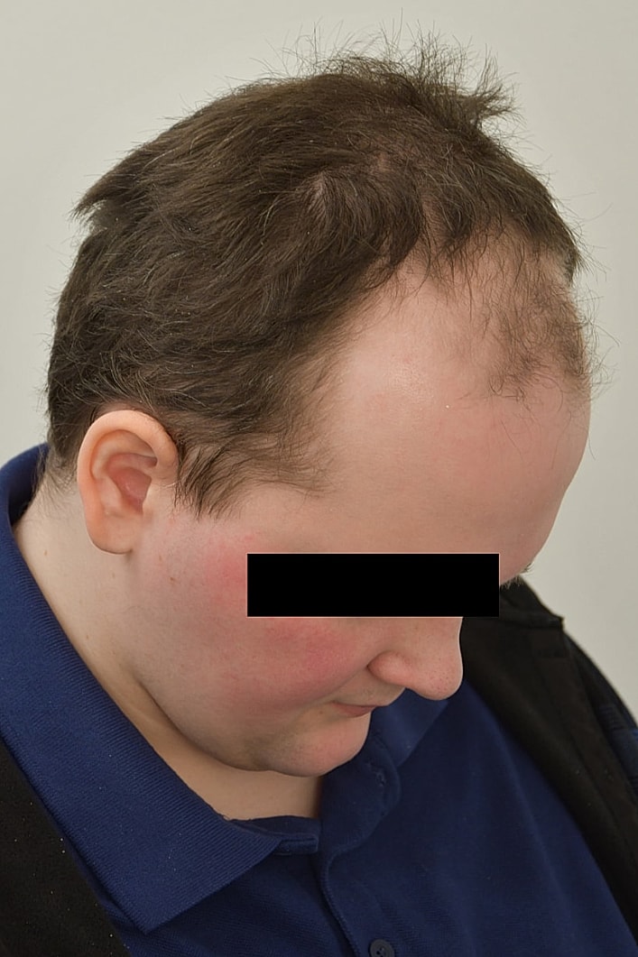 Facial Feminization Surgery Before & After