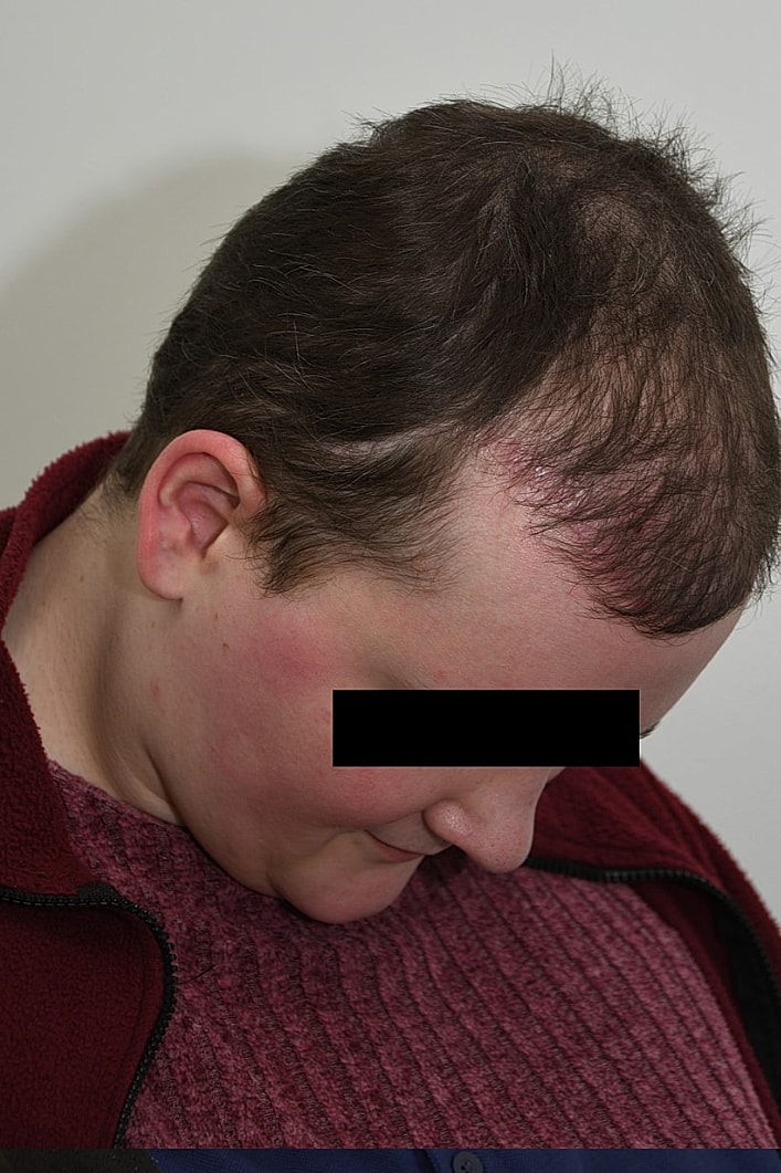 Facial Feminization Surgery Before & After