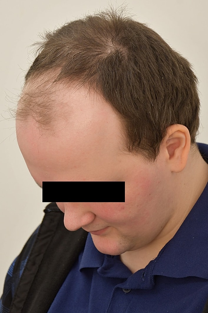 Facial Feminization Surgery Before & After