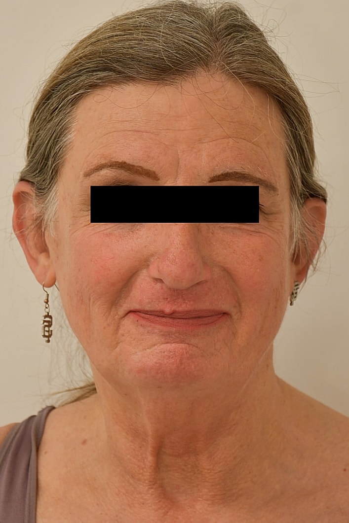 Facial Feminization Surgery Before & After