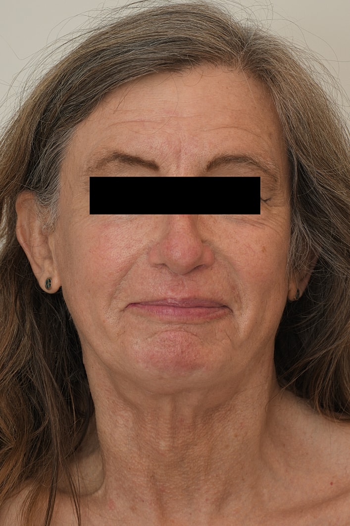 Facial Feminization Surgery Before & After