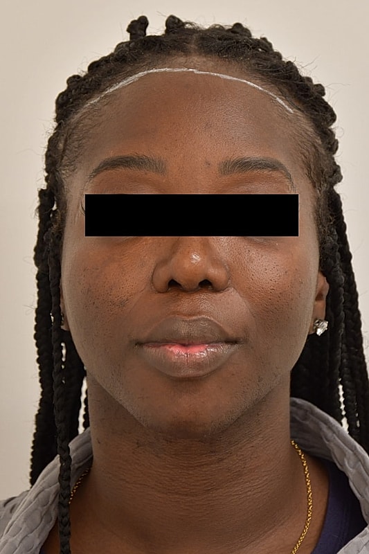 Facial Feminization Surgery Before & After