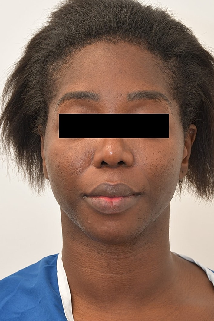 Facial Feminization Surgery Before & After