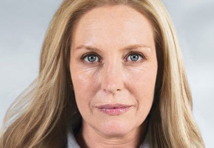 Sculptra Before & After