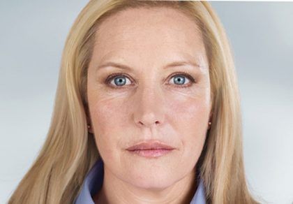 Sculptra Before & After