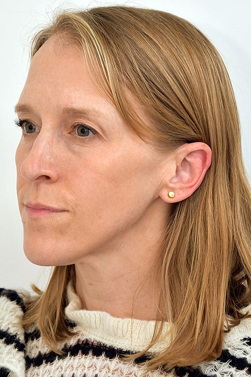 Brow Lift Before & After