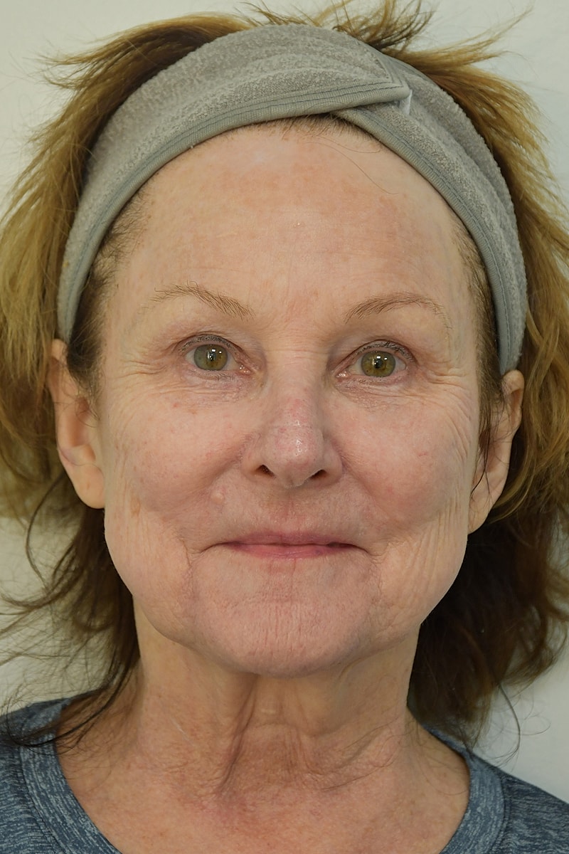 Brow Lift Before & After