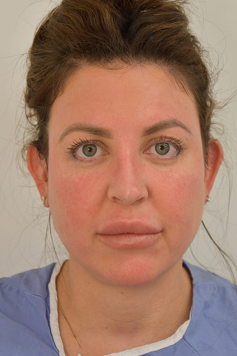 Brow Lift Before & After