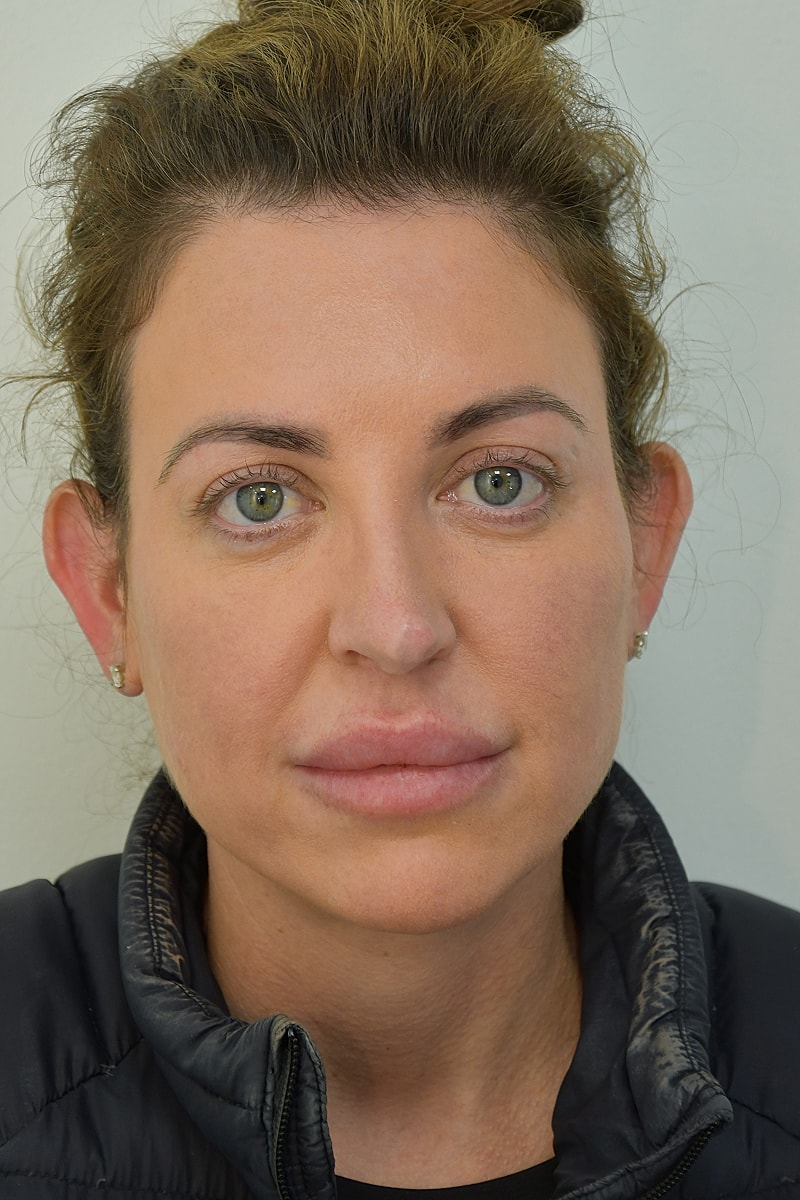 Brow Lift Before & After