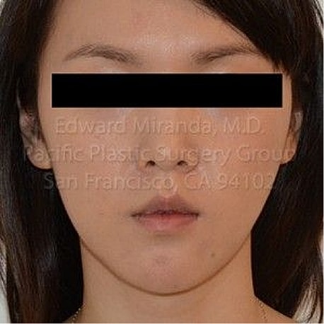 Jaw Reduction Before & After