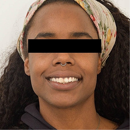 Jaw Reduction Before & After