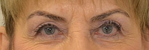 Blepharoplasty Before & After