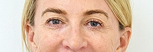 Blepharoplasty Before & After
