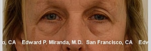 Blepharoplasty Before & After