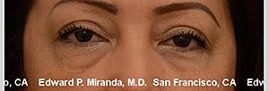 Blepharoplasty Before & After