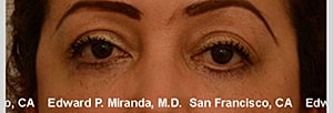 Blepharoplasty Before & After