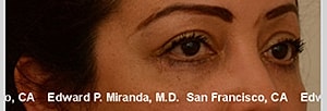 Blepharoplasty Before & After