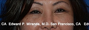Blepharoplasty Before & After