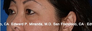 Blepharoplasty Before & After