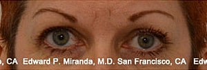 Blepharoplasty Before & After