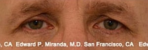 Blepharoplasty Before & After