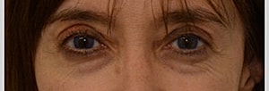 Blepharoplasty Before & After