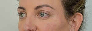 Blepharoplasty Before & After