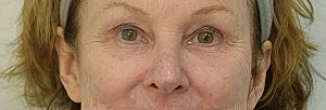 Blepharoplasty Before & After