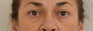 Blepharoplasty Before & After