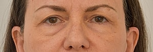Blepharoplasty Before & After