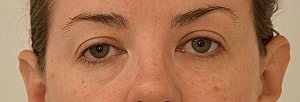 Blepharoplasty Before & After