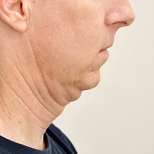 Chin Augmentation Before & After