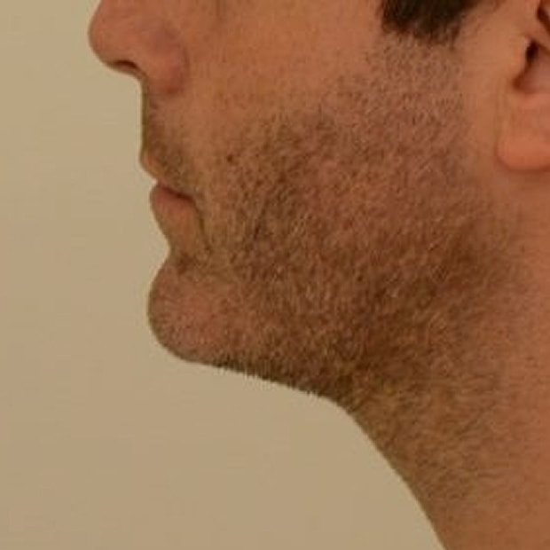 Chin Augmentation Before & After
