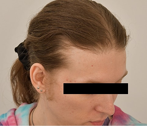 MTF Hair Gallery Before & After