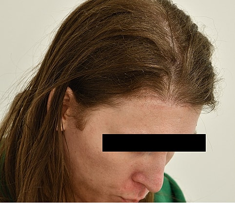 MTF Hair Gallery Before & After