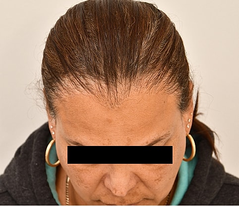 MTF Hair Gallery Before & After