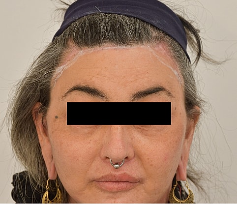 MTF Hair Gallery Before & After