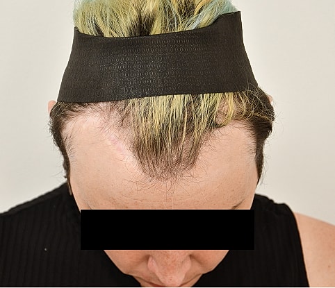 MTF Hair Gallery Before & After