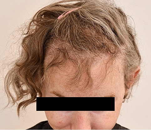 MTF Hair Gallery Before & After