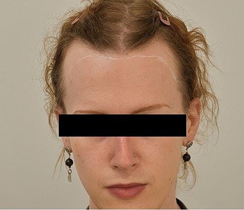 MTF Hair Gallery Before & After