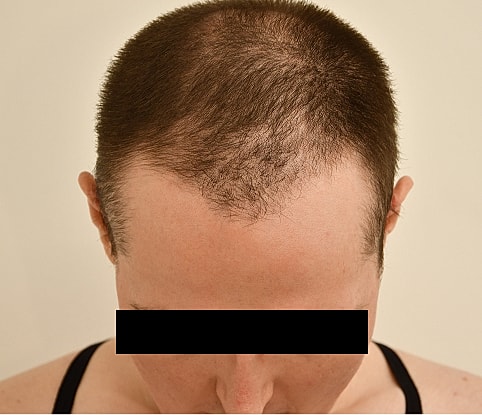 MTF Hair Gallery Before & After